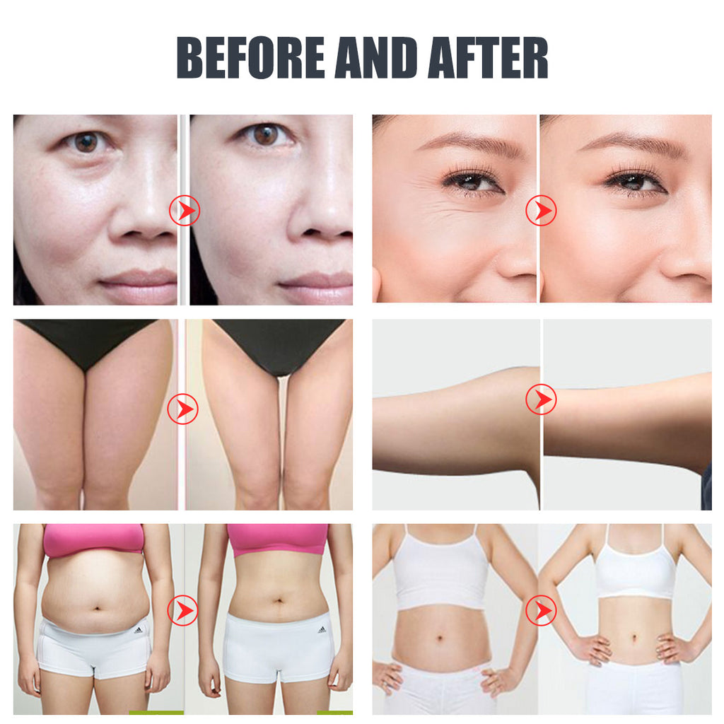 SQ47B Pro, 6in1 40K Cavitation Body Sculpting Device, Multi-Polar RF Vacuum EMS Laser for Body Contouring, Skin Smoothing & Face Skin Firming